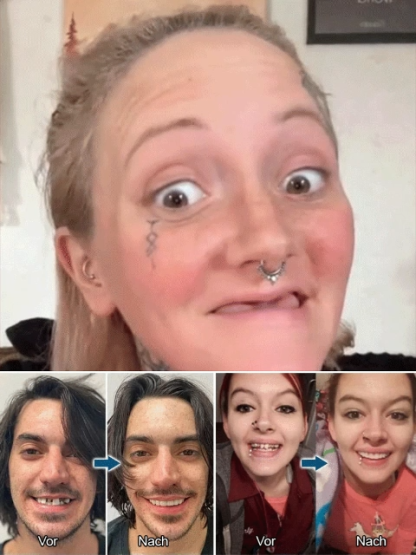 【🦷 Simulated All-Ceramic Dentures】💖 Pain-free wear, perfect fit for the mouth - ✨ Does not irritate gums or affect eating - 💯 Indistinguishable from real teeth