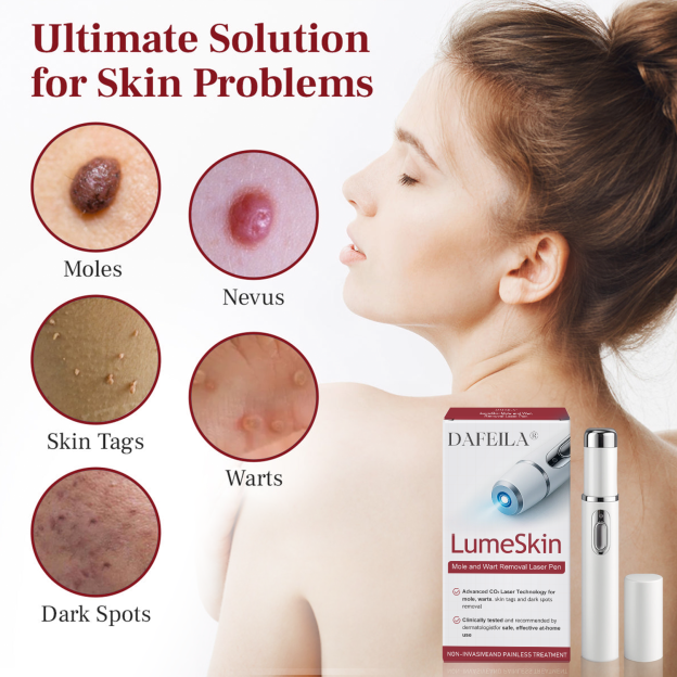 Poiultd® LumeSkin Mole and Wart Removal Laser Pen ❤️-POIULTD