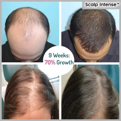 🔥Hot sale-49%OFF--SCALP INTENSE - HAIR GROWTH SERUM