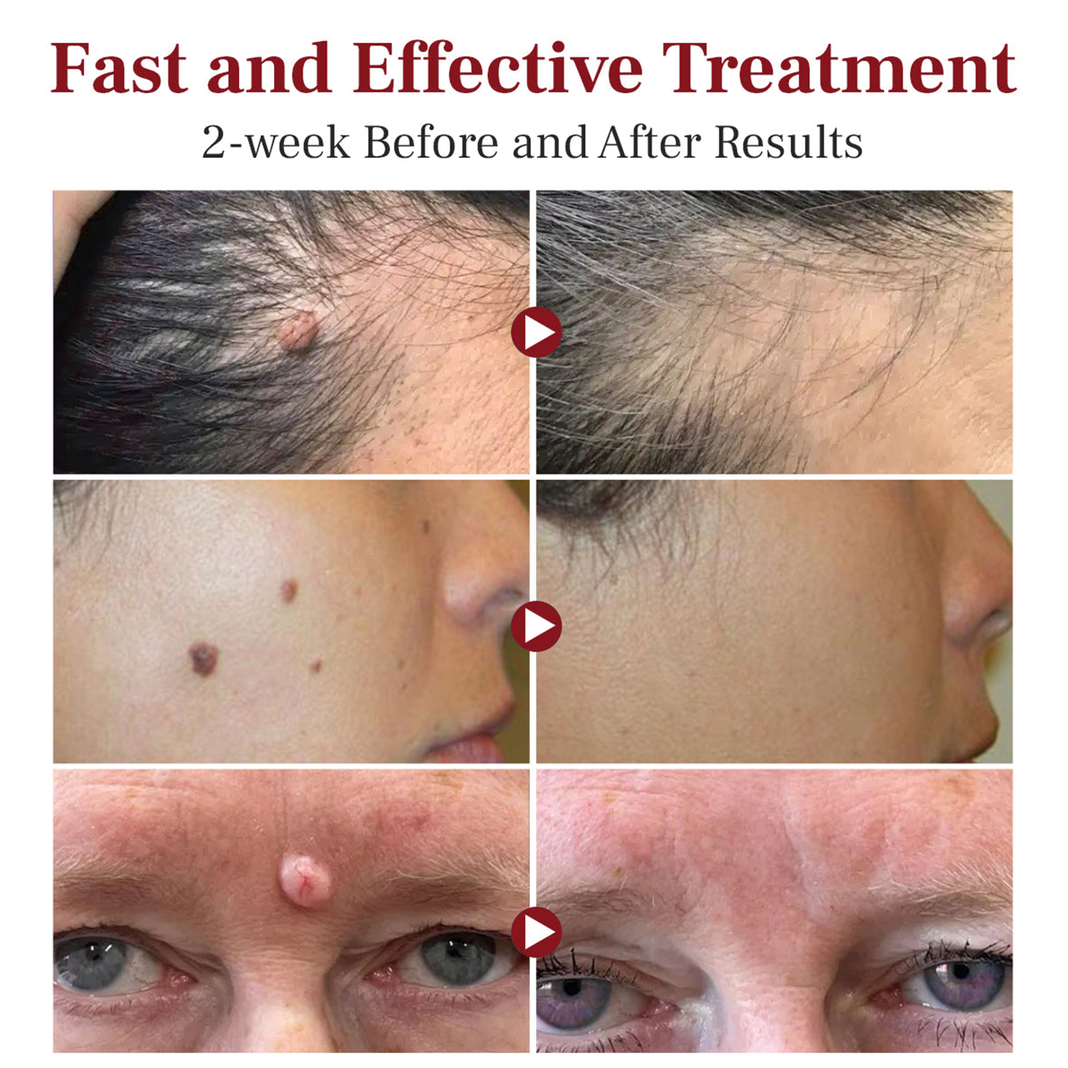 Poiultd® LumeSkin Mole and Wart Removal Laser Pen ❤️