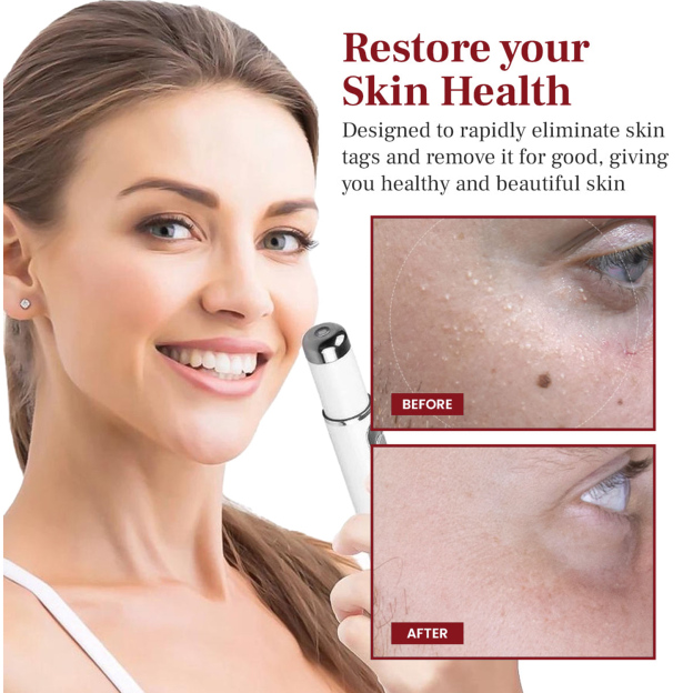Poiultd® LumeSkin Mole and Wart Removal Laser Pen ❤️-POIULTD