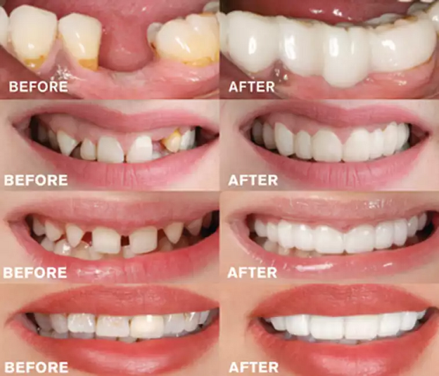 🔥🔥Last day discount-(50%off)- Adjustable dentures