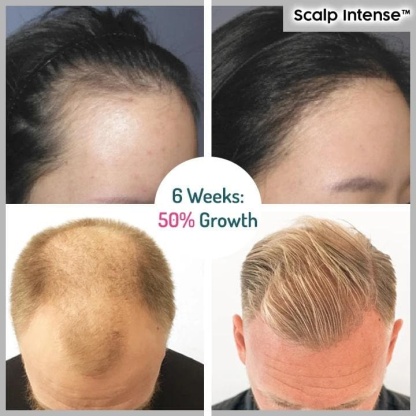 🔥Hot sale-49%OFF--SCALP INTENSE - HAIR GROWTH SERUM