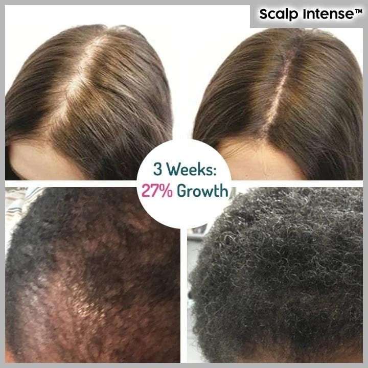 🔥Hot sale-49%OFF--SCALP INTENSE - HAIR GROWTH SERUM
