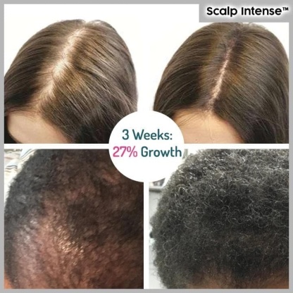 🔥Hot sale-49%OFF--SCALP INTENSE - HAIR GROWTH SERUM