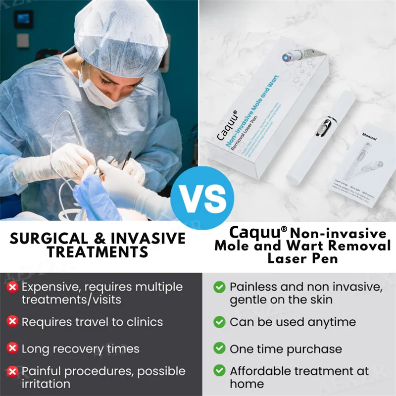 Caquu® Non-Invasive Mole and Wart Removal Laser Pen
