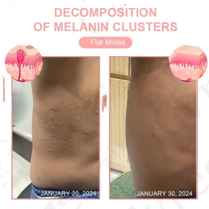 Lepeaa® Dual Acid Wart & Mole Removal Serum