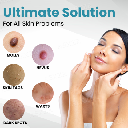 Caquu® Non-Invasive Mole and Wart Removal Laser Pen
