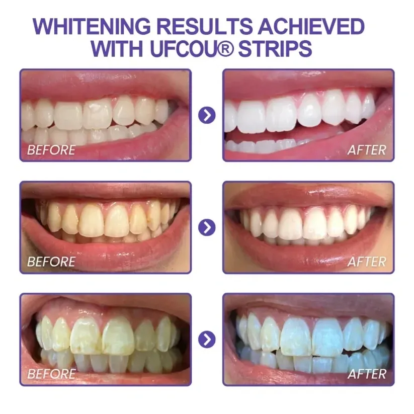 Ufcou® Purple Whitening Teeth Strips