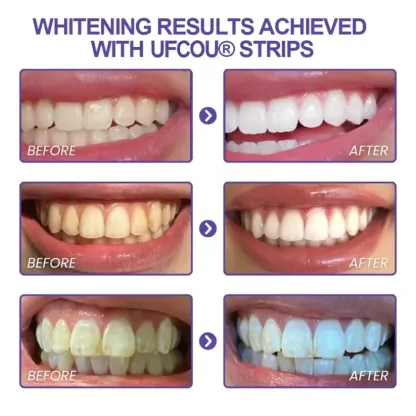 Ufcou® Purple Whitening Teeth Strips
