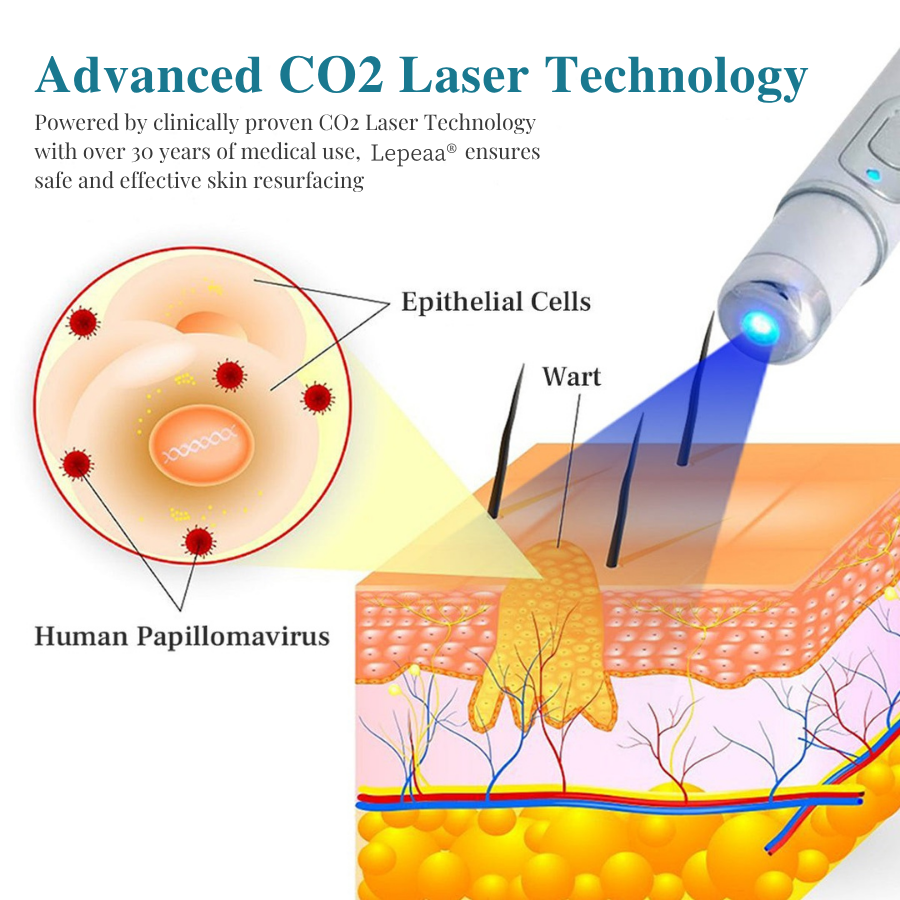 Lepeaa® LumeSkin Mole and Wart Removal Laser Pen
