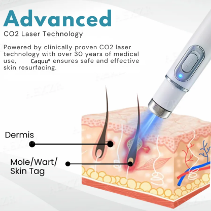 Caquu® Non-Invasive Mole and Wart Removal Laser Pen
