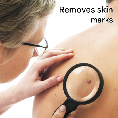 Wart Remover Cream