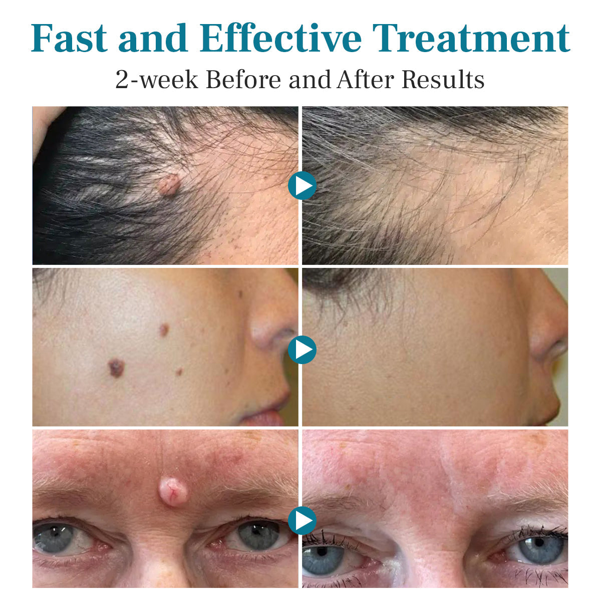 Lepeaa® LumeSkin Mole and Wart Removal Laser Pen
