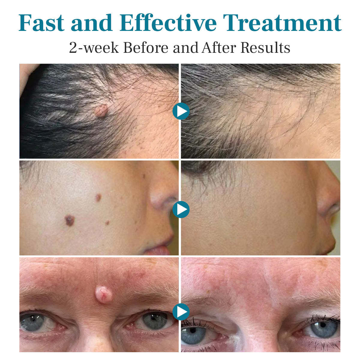 Lepeaa® LumeSkin Mole and Wart Removal Laser Pen