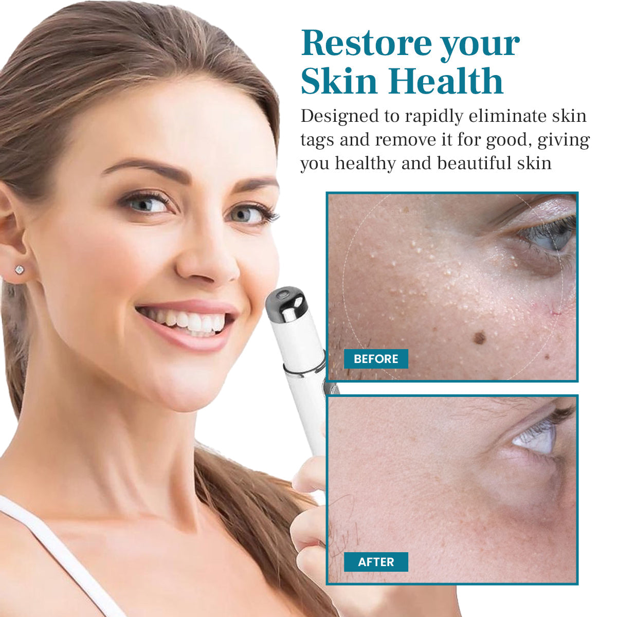 Lepeaa® LumeSkin Mole and Wart Removal Laser Pen
