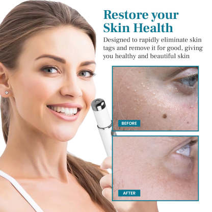 Lepeaa® LumeSkin Mole and Wart Removal Laser Pen