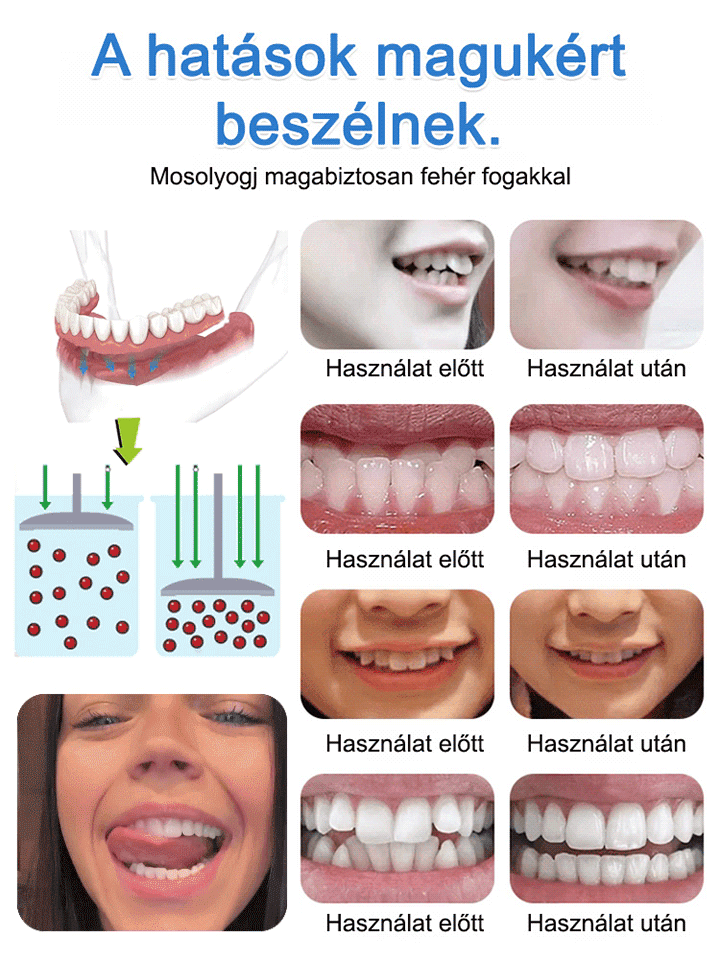 Visszanyert magabiztos mosoly! Az önadaptív anyag stabil illeszkedést garantál: nincs elmozdulás, még alma rágásánál sem.