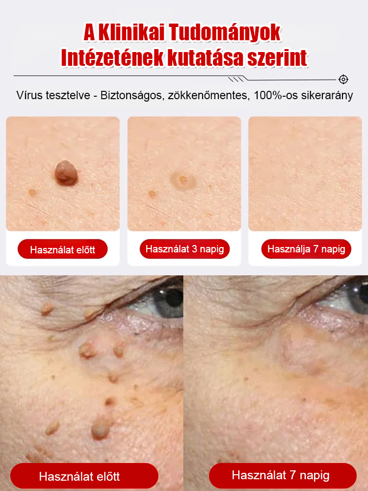 Svájci szakértelem: Sima bőr szemölcsök és hegek nélkül! 
