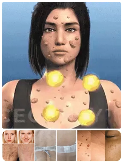 Svájci szakértelem: Sima bőr szemölcsök és hegek nélkül! 