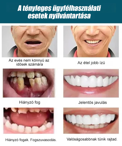Állítható bepattintható műfogsor