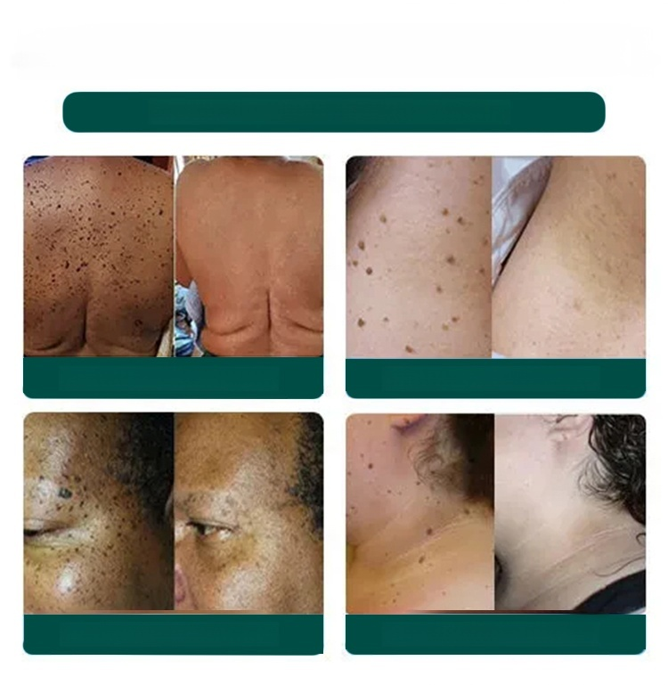 Wart Removal Quick Repair Patch