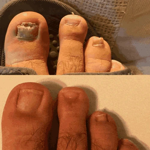 Dyipa™ Say goodbye to nail fungus