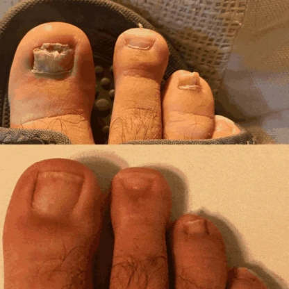 Dyipa™ Say goodbye to nail fungus