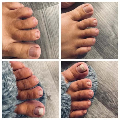 Dyipa™ Say goodbye to nail fungus