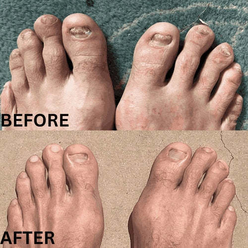 Dyipa™ Say goodbye to nail fungus