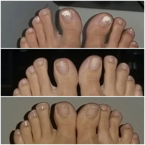 Dyipa™ Say goodbye to nail fungus