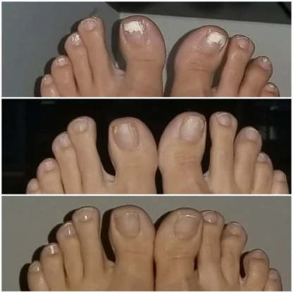 Dyipa™ Say goodbye to nail fungus