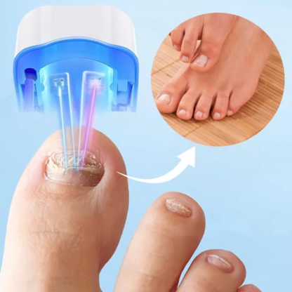 Dispositivo Láser para Limpiar Hongos en Uñas