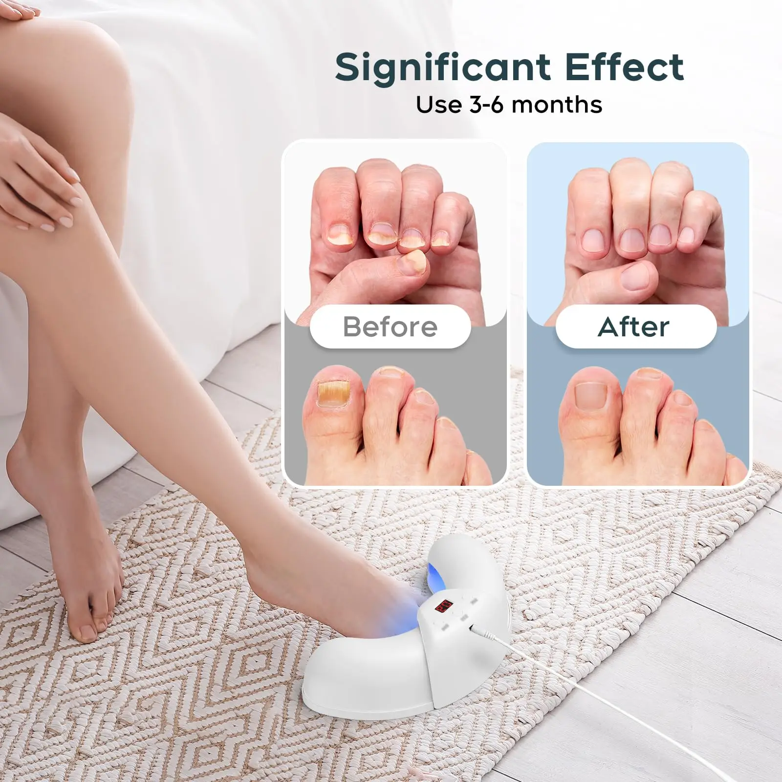 Dispositivo láser para hongos en las uñas de los pies y de las manos Solución reparadora de uñas dañadas y descoloridas para uso doméstico