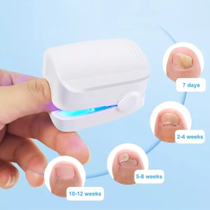 Dispositivo Láser para Limpiar Hongos en Uñas