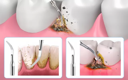 Eliminador Ultrasónico de Sarro Dental
