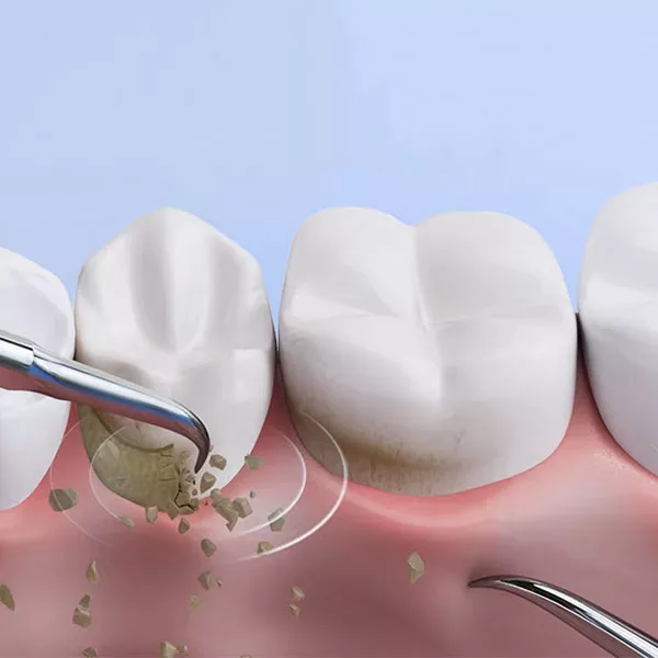 Eliminador Ultrasónico de Sarro Dental