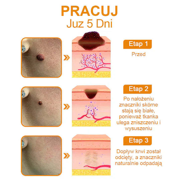 【🌊 Za pobraniem🌊 】 Vsoxa™ Krem do usuwania brodawek i pieprzyków z jadem pszczelim (👨⚕Zalecenia AAD) 🐝🐝 (🔥Ostatni dzień wyprzedaży 70% taniej)