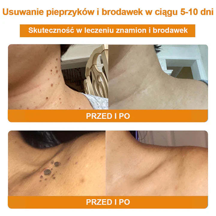 【🌊 Za pobraniem🌊 】 Vsoxa™ Krem do usuwania brodawek i pieprzyków z jadem pszczelim (👨⚕Zalecenia AAD) 🐝🐝 (🔥Ostatni dzień wyprzedaży 70% taniej)