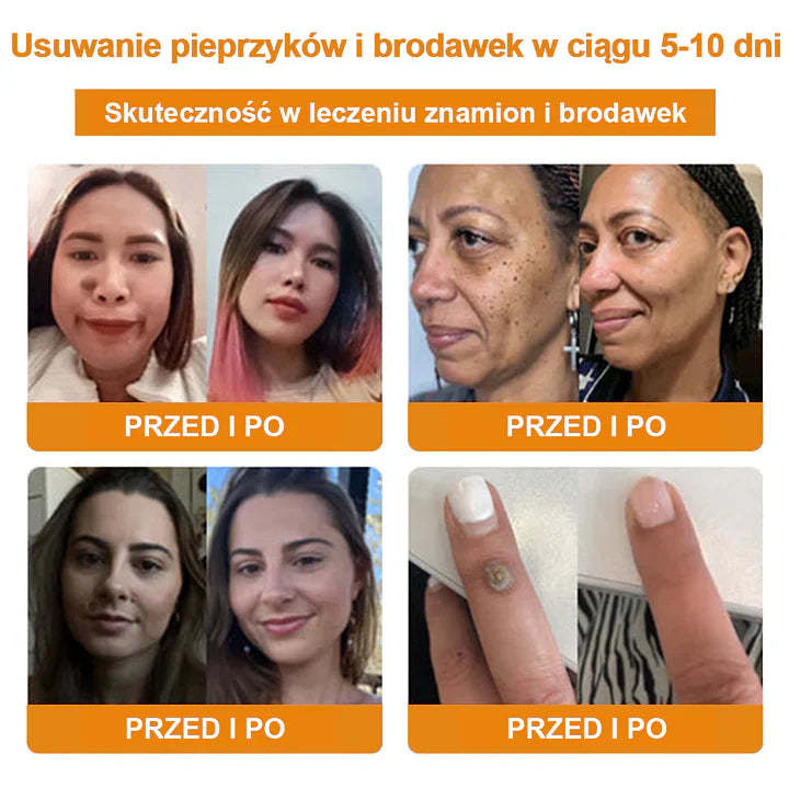 【🌊 Za pobraniem🌊 】 Vsoxa™ Krem do usuwania brodawek i pieprzyków z jadem pszczelim (👨⚕Zalecenia AAD) 🐝🐝 (🔥Ostatni dzień wyprzedaży 70% taniej)