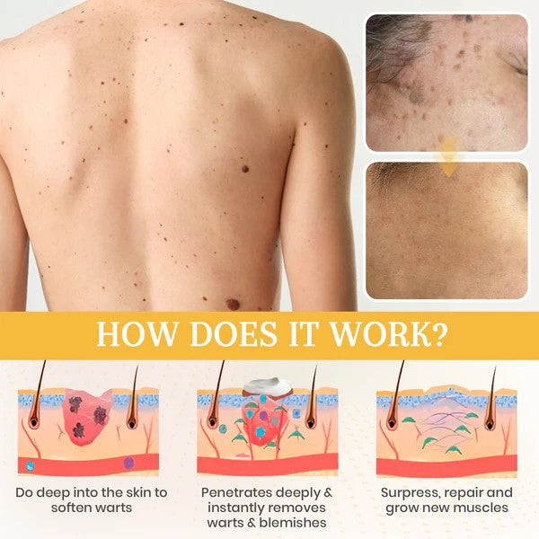 Lepeaa® DermaErase Advanced Mole & Spot Removal Gel