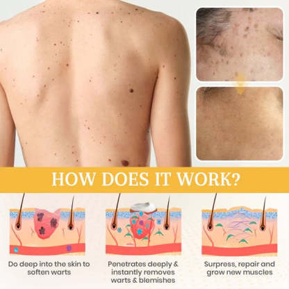 Lepeaa® DermaErase Advanced Mole & Spot Removal Gel