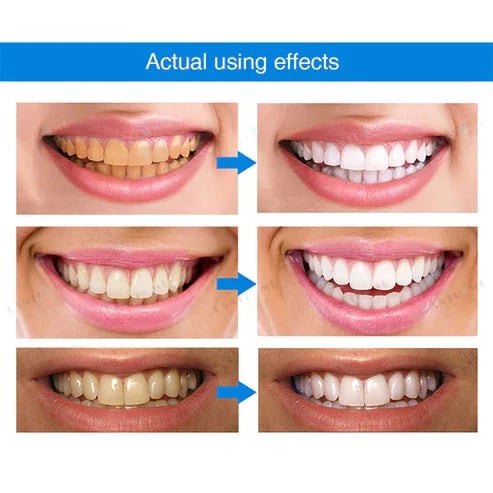 🔥Last Day Promotion 49% OFF🔥-Teeth Whitening Essence