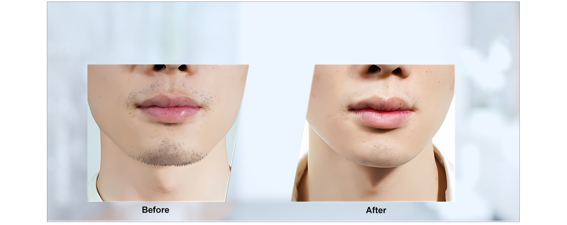 {"default":"laser depilation machine"}