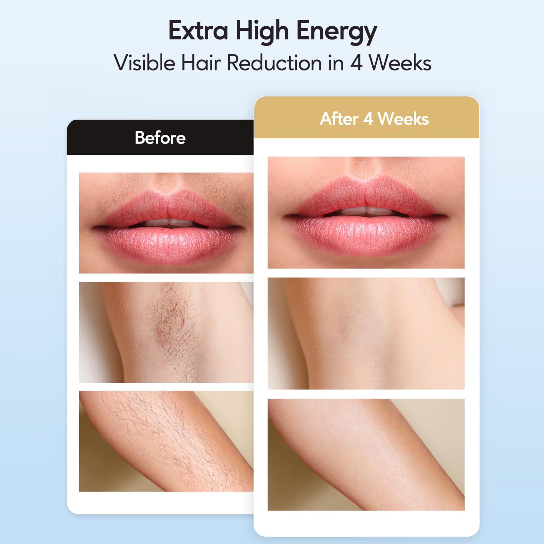 IPL Hair Removal Device Home Use Ipl Machine Laser Hair Removal Permanent Removing Hair Painless At-home 3 in 1-Aolemon