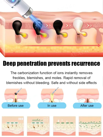 Laser Painless Wart Removal Pen 🌼 Painless & Scar-free Healing, Total Peace of Mind for Sensitive Skin