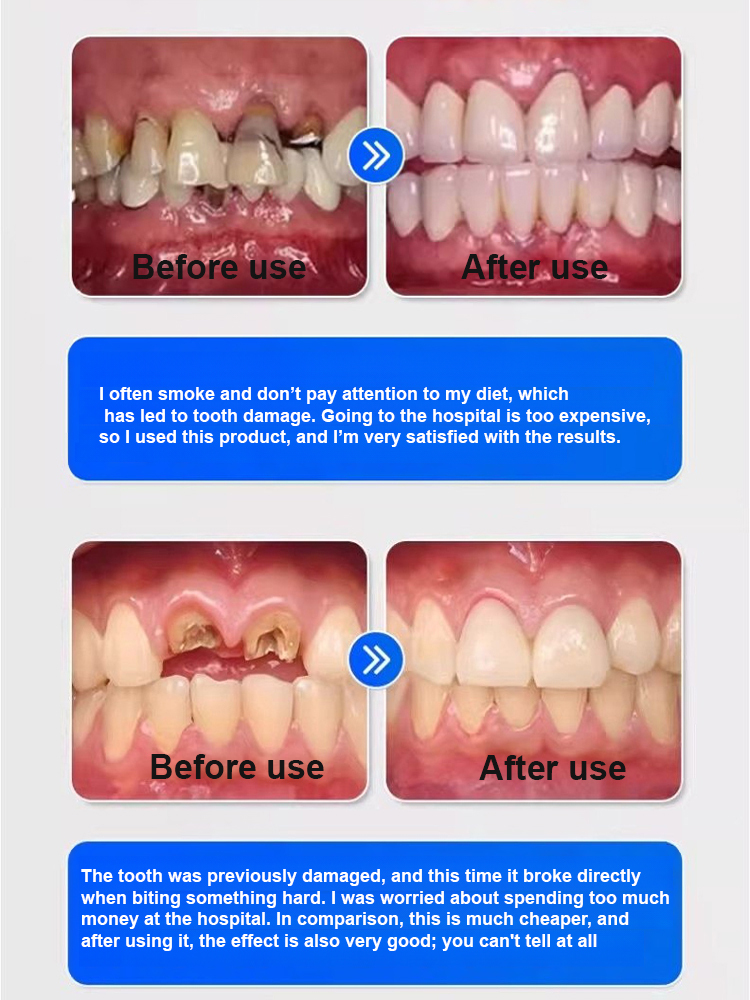 Thermal Forming Dentures – Fix Teeth at Home Easily, Master in 1 Minute! 😊 100% Natural Material, FDA Approved ✅