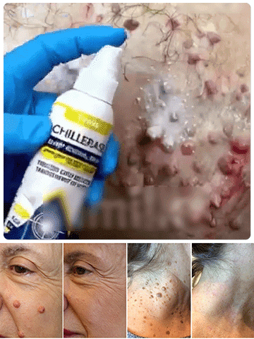 [Painless Wart & Tag Remover Spray] Fast-Acting Clear Skin Formula — No Recurrence