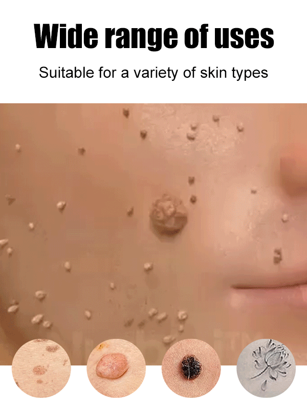 Laser Painless Wart Removal Pen 🌼 Painless & Scar-free Healing, Total Peace of Mind for Sensitive Skin