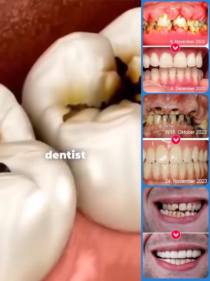 🦷Zahnschmelz-Reparaturserum: Deutsche Innovation für Ihre Zahngesundheit! Jahresend-Special!💫 Nur für kurze Zeit: 50 % RABATT!🔥